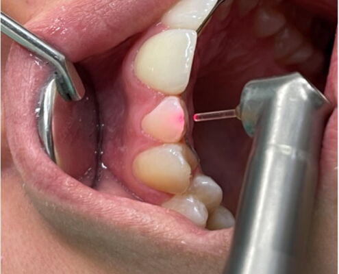 Geöffneter Mund mit Blick auf eine Laserbehandlung an einem Schneidezahn