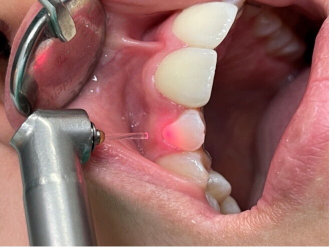 Geöffneter Mund mit Blick auf eine Laserbehandlung an einem Schneidezahn